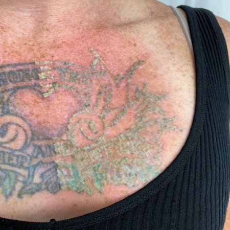 Painless tattoo removal
