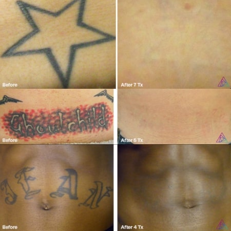 Advanced tattoo removal services in Fort Lauderdale FL