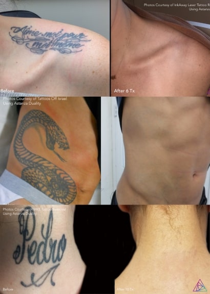 Tattoo removal services in Lauderdale